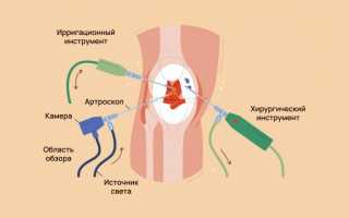 Лечение ревматоидного артрита