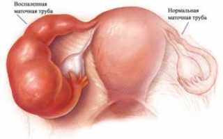 Двухсторонний сальпингит: причины и признаки, лечение, влияние на беременность