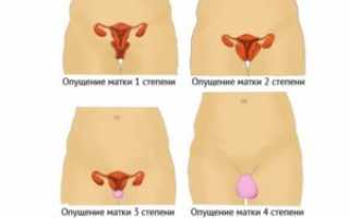 Как определить опущение матки по симптоматике и в ходе исследований?