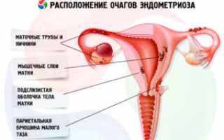 Хирургическое вмешательство при эндометриозе