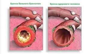 Симптомы и лечение бронхита