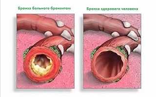 Симптомы и лечение бронхита