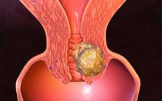 Карциносаркома матки: лечение онкологического процесса и прогноз