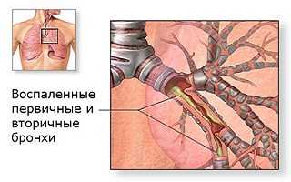 Лечение воспаленных бронхов