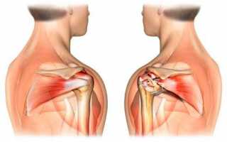 Почему происходит разрыв связок плечевого сустава. Диагностика и лечение травмы