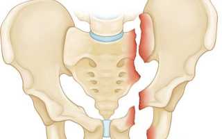 Перелом костей таза