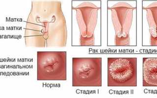 Последствия рака шейки матки: особенности и клиническая картина