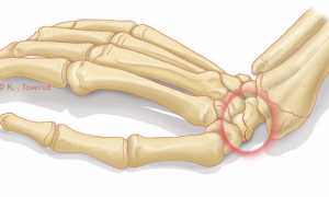 Перелом ладьевидной кости кисти