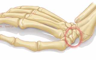 Перелом ладьевидной кости кисти