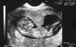 Тонус матки при беременности в 3 триместре: патология или нет?