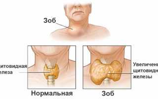 Эндемический зоб — симптомы, виды и последствия заболевания