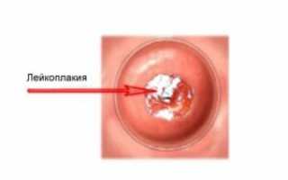 Как проводят радиоволновое лечение лейкоплакии шейки матки?