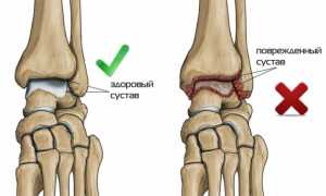 Артроз голеностопного сустава