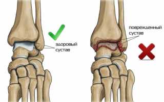 Артроз голеностопного сустава