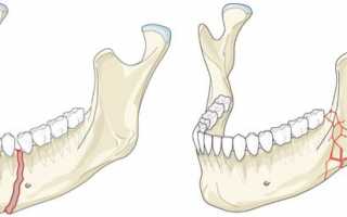 Перелом нижней челюсти