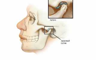Как лечить артроз челюстного сустава?