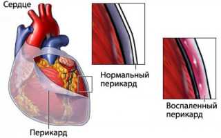 Ревматизм сердца