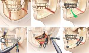 Шинирование челюсти при переломе