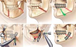 Шинирование челюсти при переломе