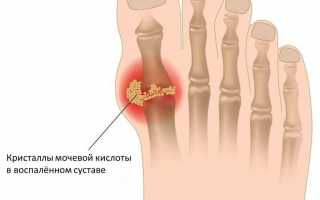 Причины возникновения и лечение подагры на ногах