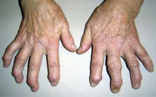 Боль в косточках на пальцах рук