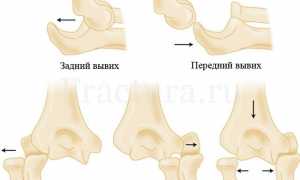 Вывих предплечья: 25% от общего числа вывихов