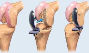 Восстановление после эндопротезирования коленного сустава