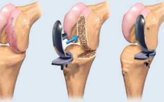 Восстановление после эндопротезирования коленного сустава