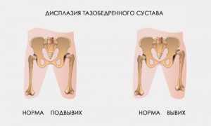 Дисплазия тазобедренных суставов