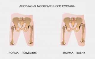 Дисплазия тазобедренных суставов