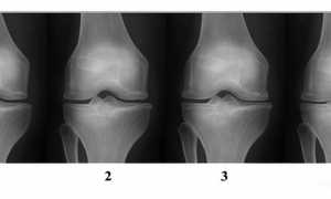 Лечение гонартроза коленного сустава 3 степени