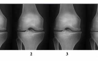 Лечение гонартроза коленного сустава 3 степени