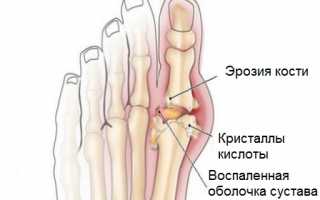 Аллопуринол при подагре