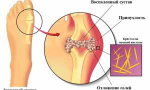 Подагрический артрит