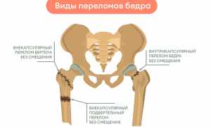 Перелом тазобедренного сустава