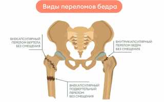 Перелом тазобедренного сустава