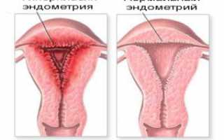 Вероятность рецидивирующей гиперплазии эндометрия