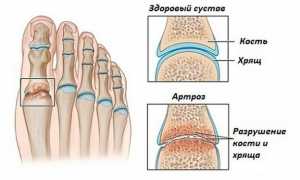 Артроз суставов стопы