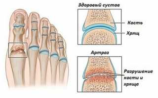 Артроз суставов стопы