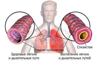 Осложнения гриппа. Легкие