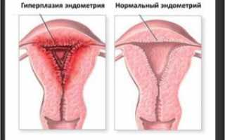 Диета при гиперплазии эндометрия – обоснованная необходимость