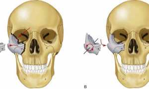 Перелом скуловой кости