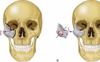 Перелом скуловой кости