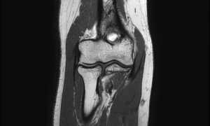МРТ локтевого сустава