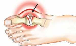Снятие приступа подагры
