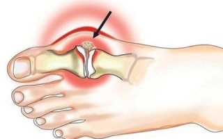 Тофусы при подагре