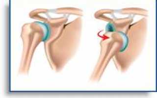 Привычный вывих плеча