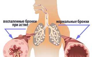 Лечение бронхиальной астмы в домашних условиях