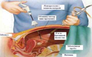 Внематочная беременность в яичнике: симптомы, диагностика и лечение