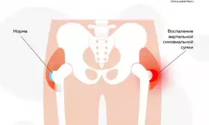 Бурсит тазобедренного сустава